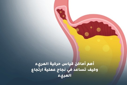 أهم أماكن قياس حركية المريء وكيف تساعد في نجاح عملية ارتجاع المريء