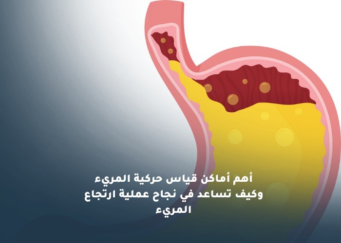 أهم أماكن قياس حركية المريء وكيف تساعد في نجاح عملية ارتجاع المريء