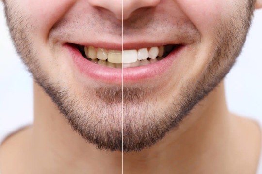 طرق فعالة للحفاظ على تبييض الاسنان بعد التبييض في العيادة