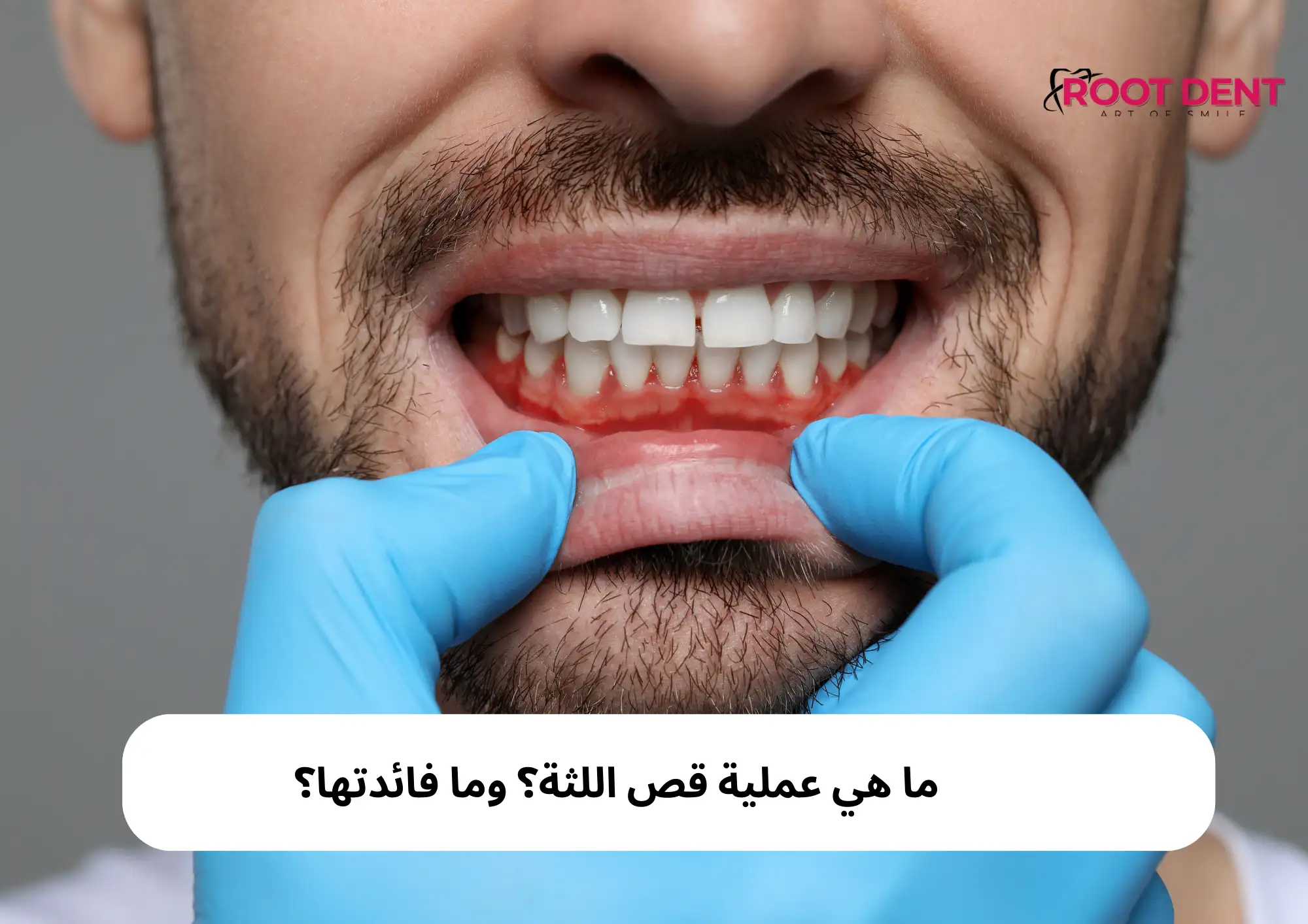 ما هي عملية قص اللثة؟ وما فائدتها؟